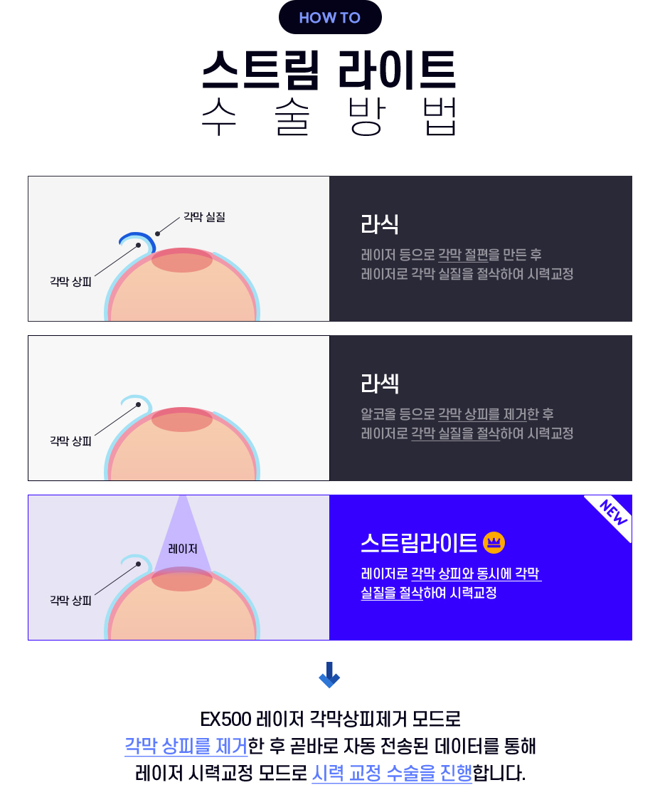 스트림라이트 수술방법
