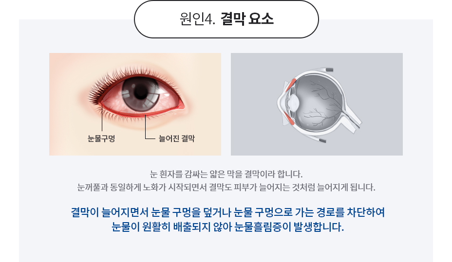 눈물흘림증의 원인