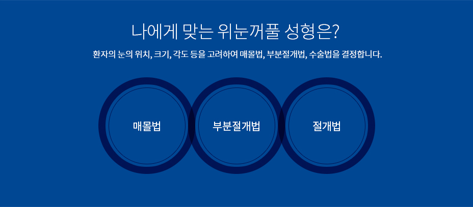 위눈꺼풀 성형의 특장점