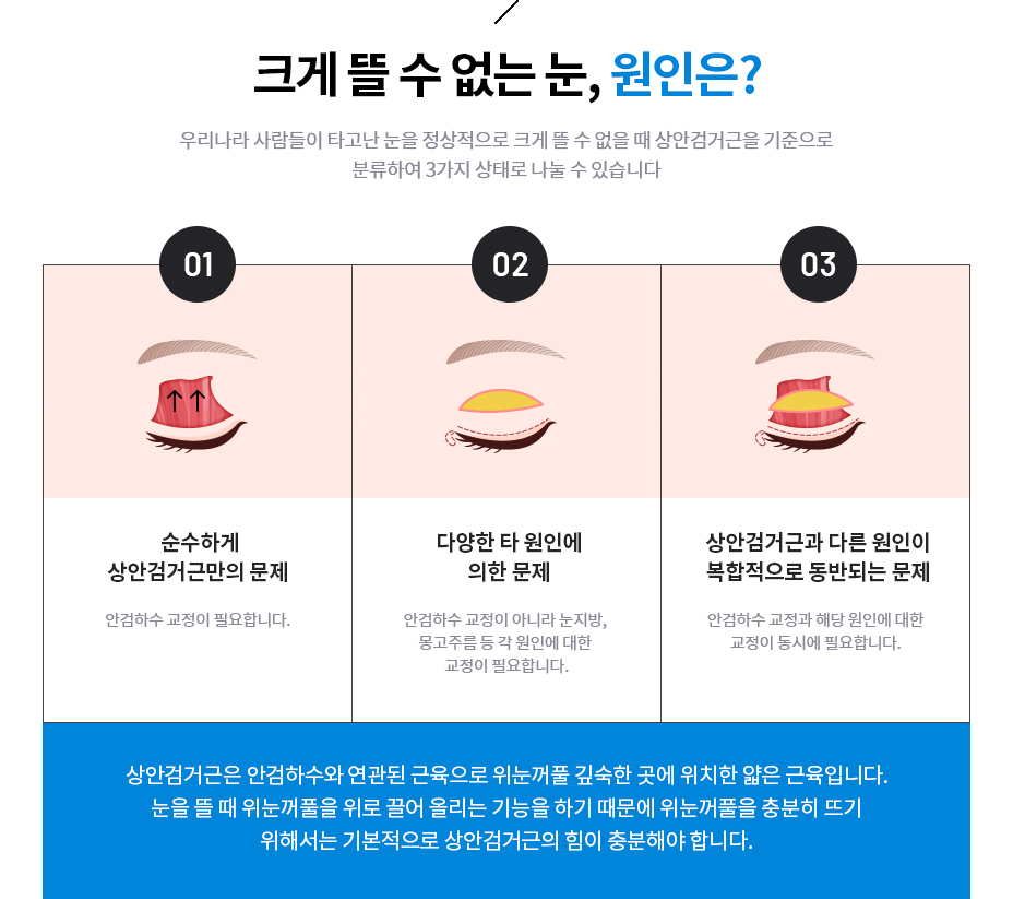 안검하수 원인