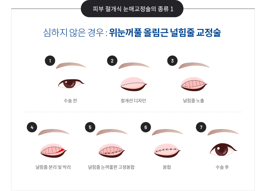 안검하수의 치료