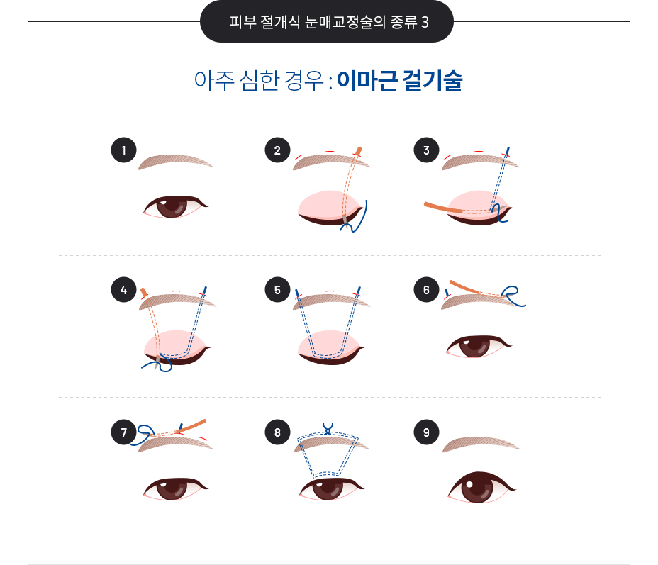 안검하수의 치료