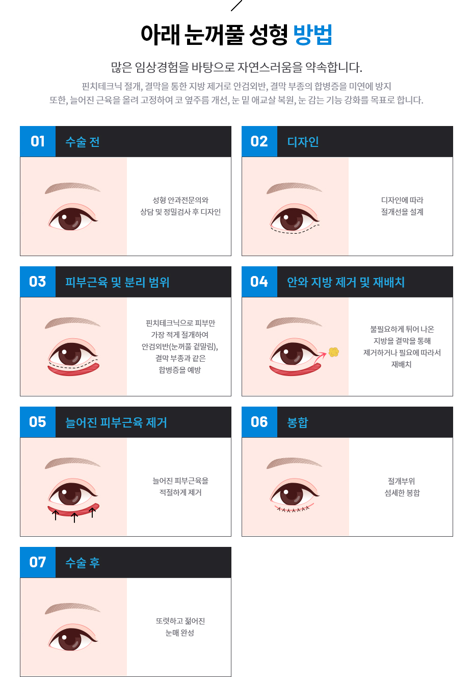 아래 눈꺼풀 성형 방법