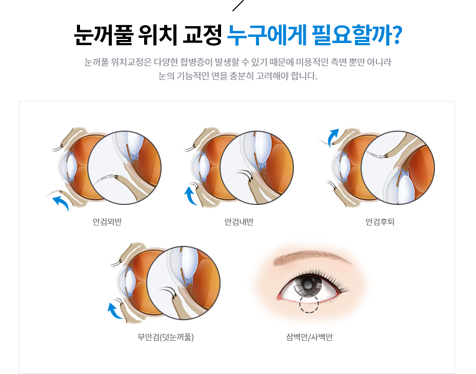 눈꺼풀 위치 교정 누구에게 필요할까?