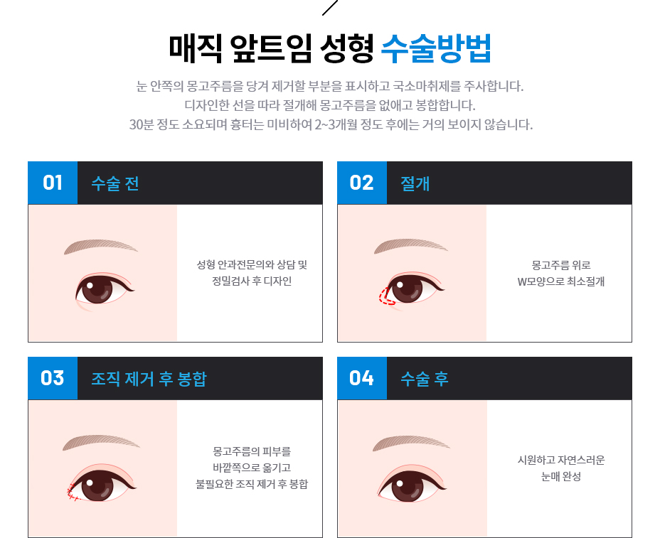 앞트임 성형 수술방법