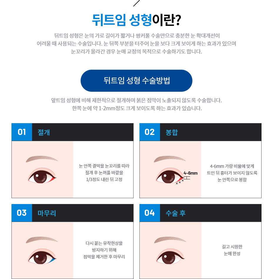 뒤트임 성형이란?