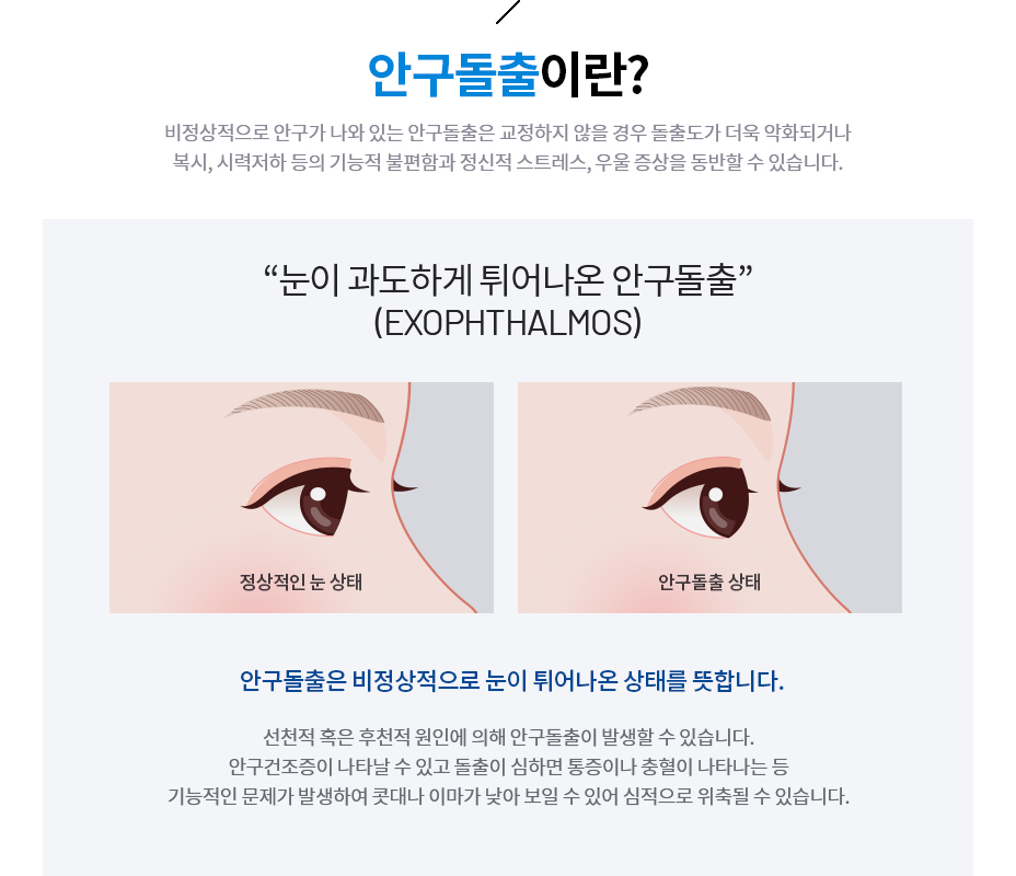안구돌출이란?